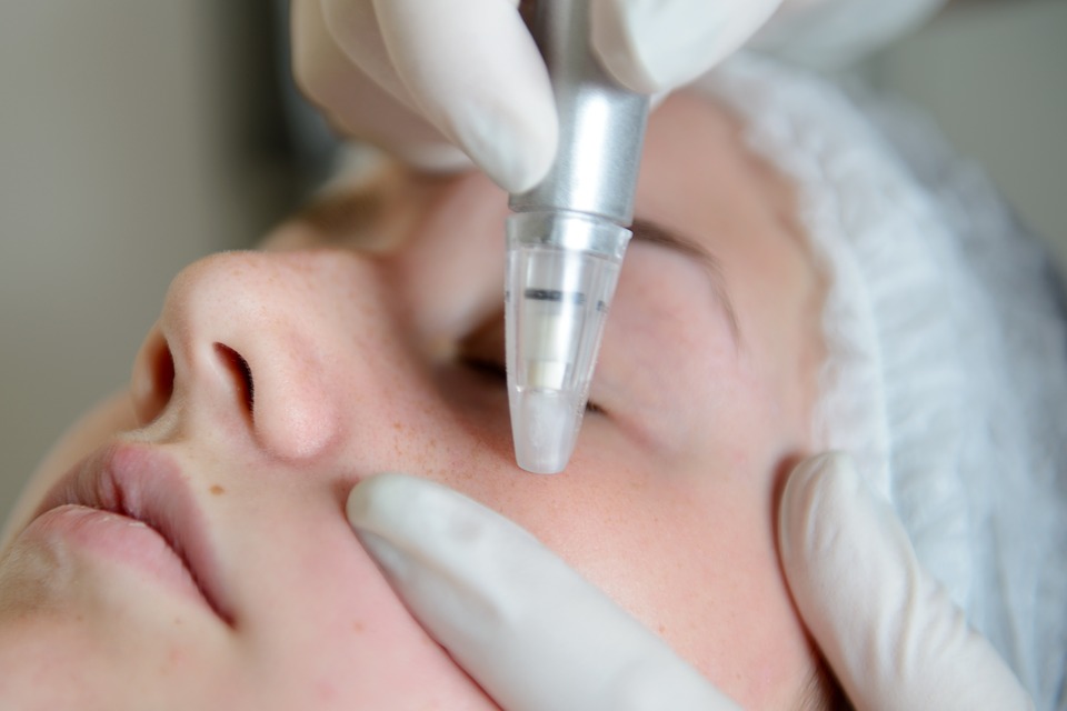 Photo of a face receiving microdermabrasion facial